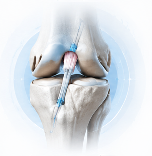 ACL anterior cruciate ligament reconstruction knee surgery illustration