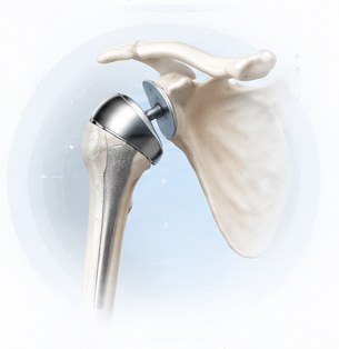 Shoulder replacement surgery artificial joint implant illustration