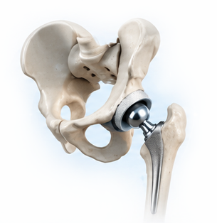 Total hip replacement THR ball and socket implant illustration