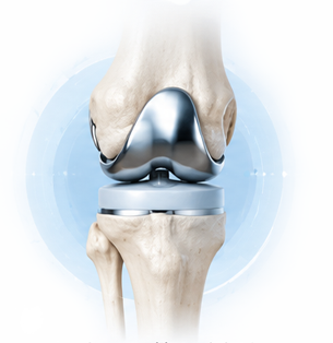 Total knee replacement TKR artificial knee joint implant illustration